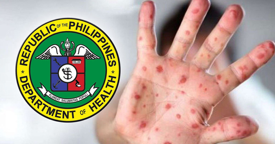 Measles cases sa CALABARZON, dumami pa